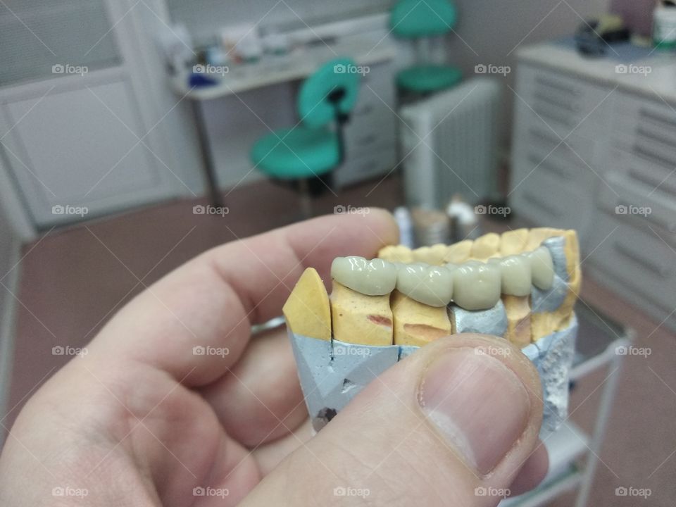 Dental Bridge on model