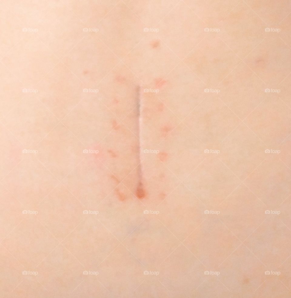 My beautiful scar after back surgery
