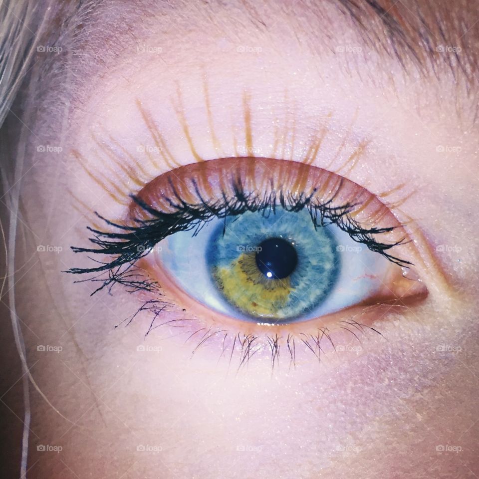 Heterochromia