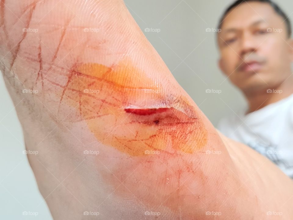 foot wound