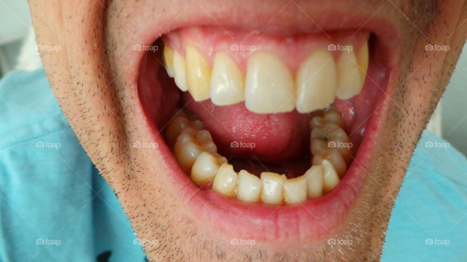 teeth with discolouration
