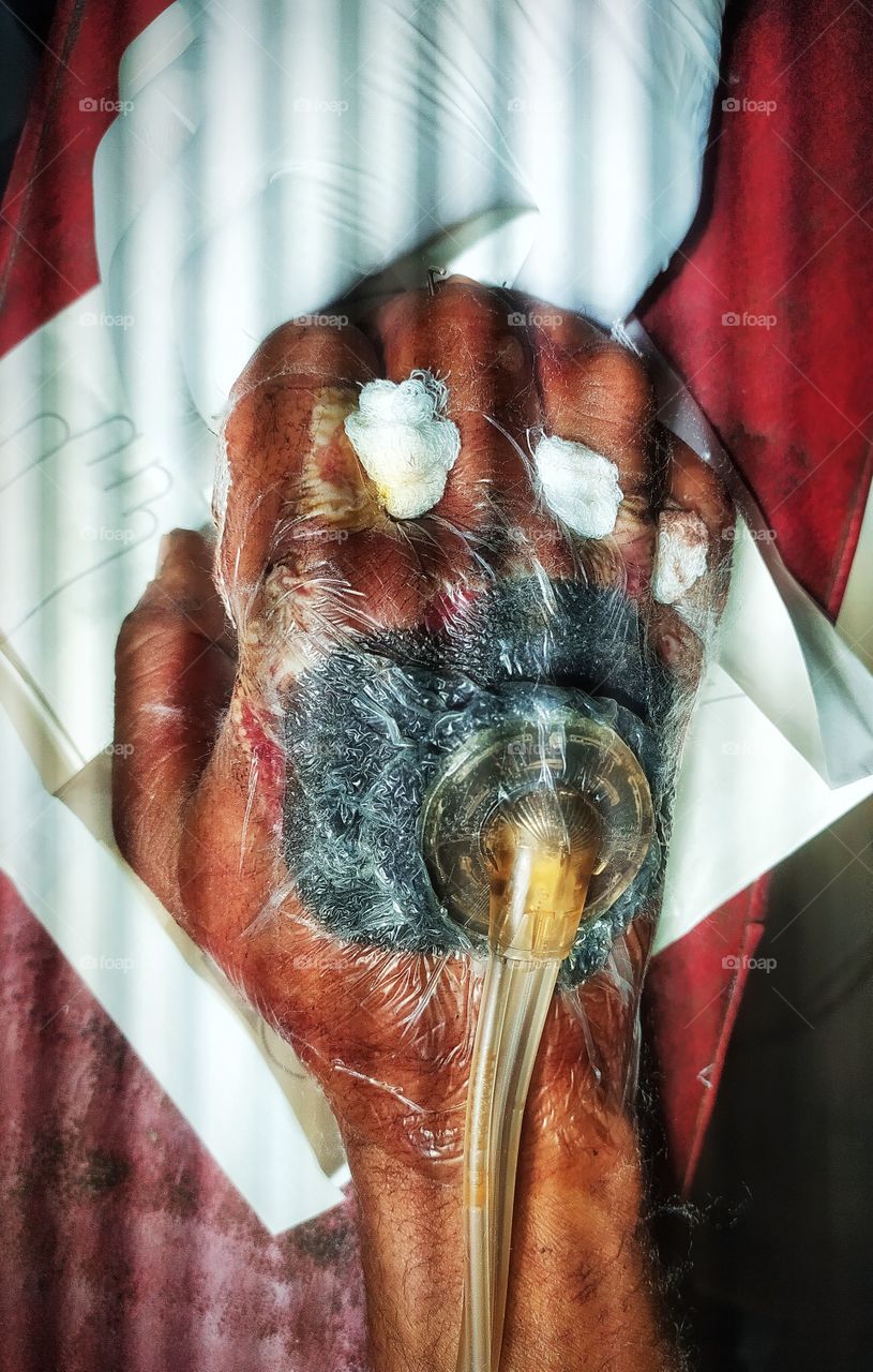 VAC DRESSING THERAPY FOR HAND VIEW SHOT ON CAMERA