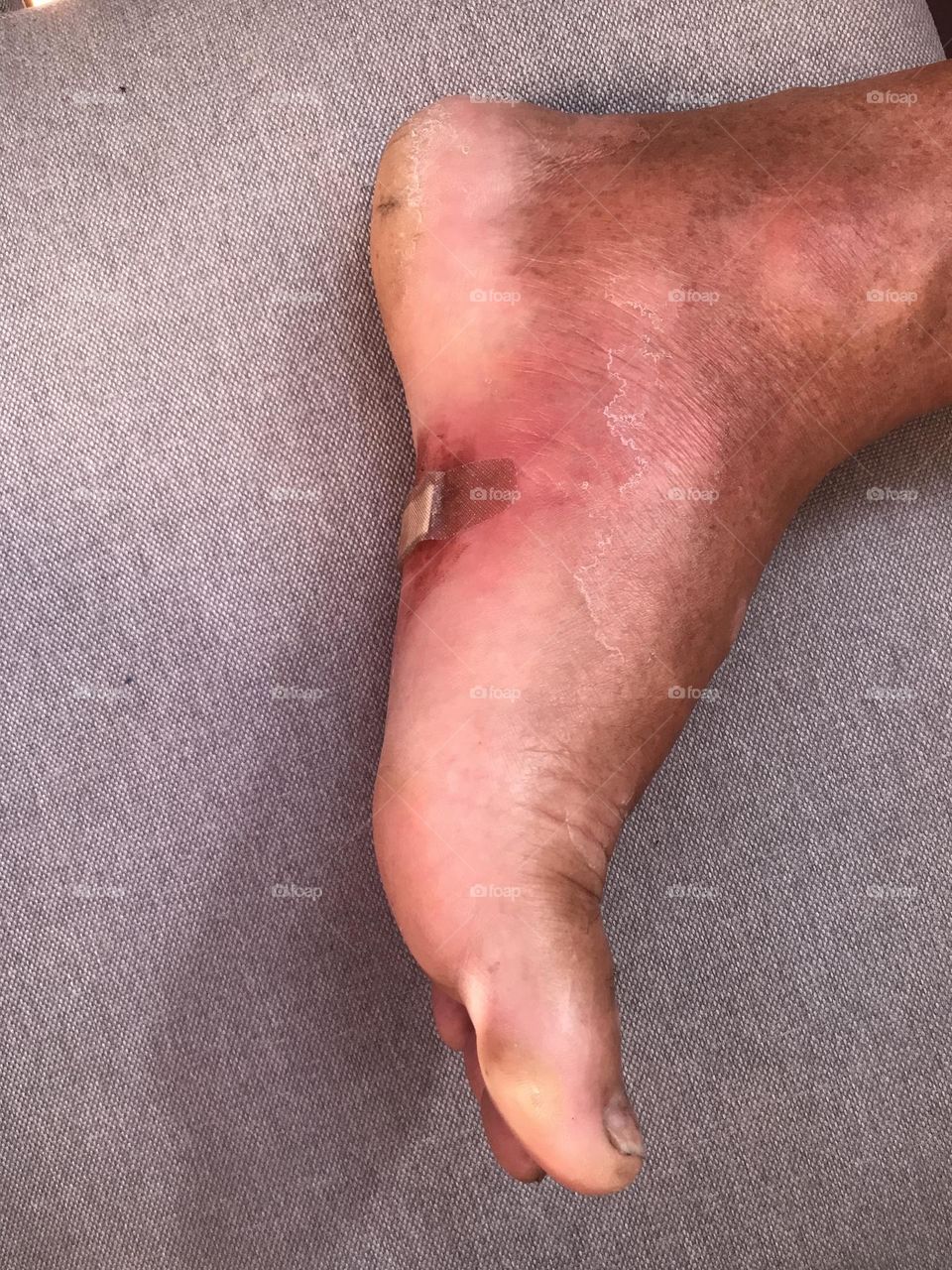 foot inflamed by lionfish bite