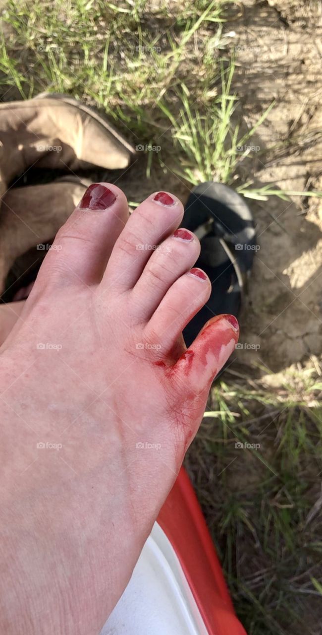 Cut my foot open at a music festival. Required a tetanus shot. 