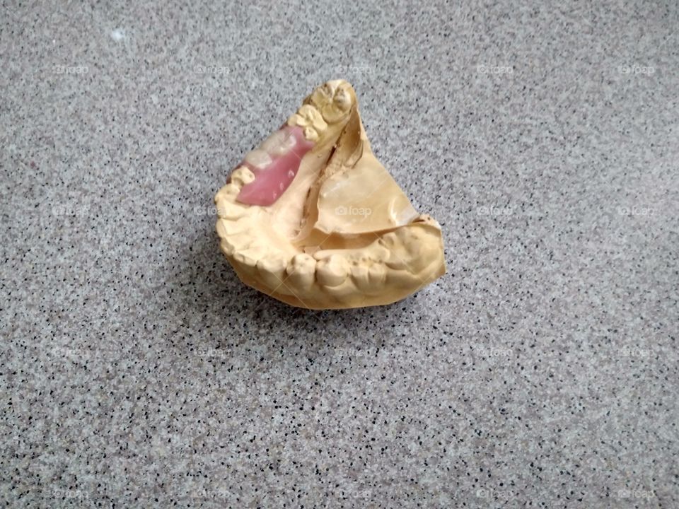 Dental model with dentures