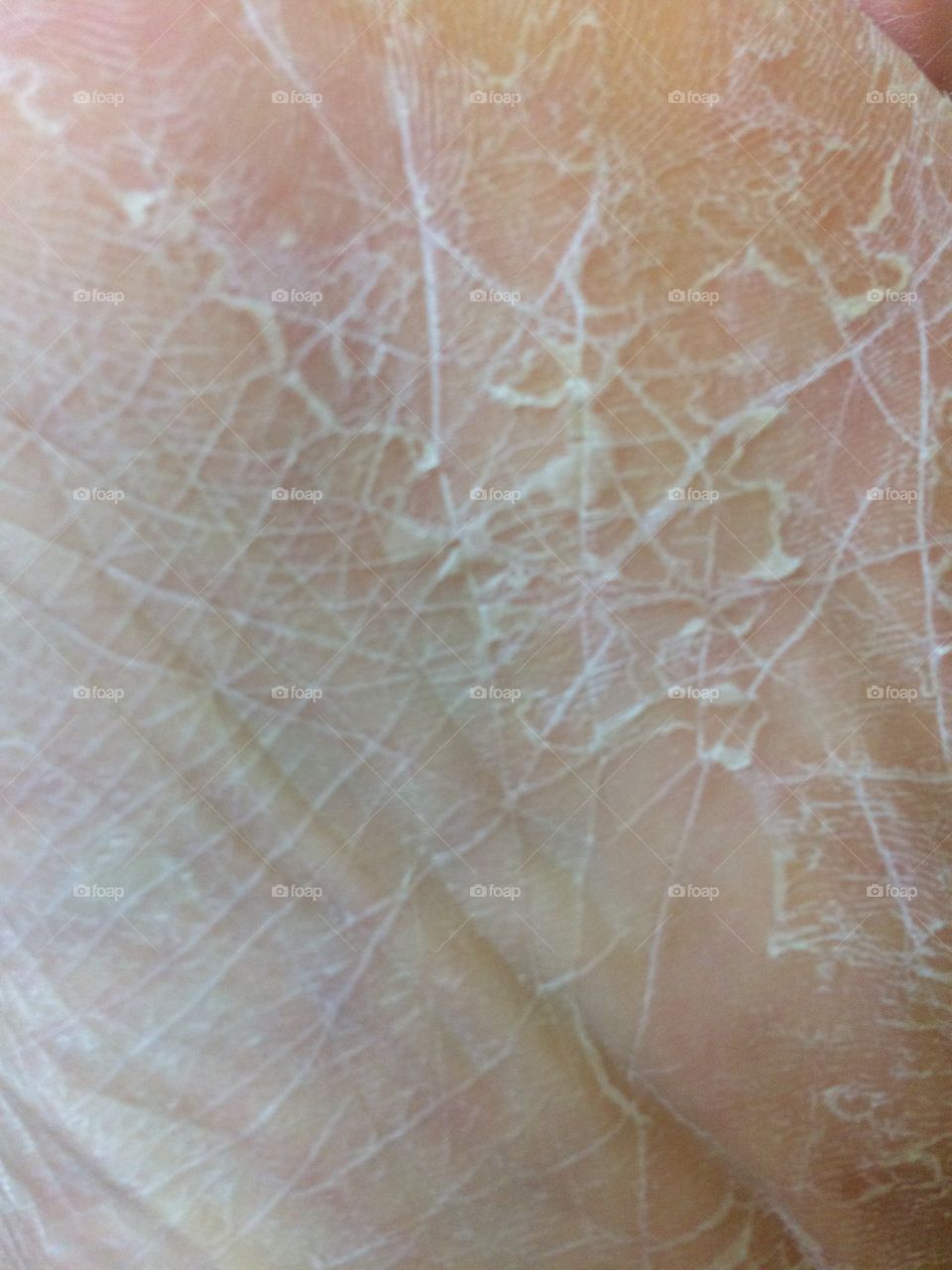 Crackle skin