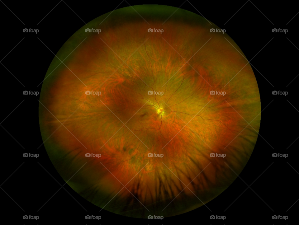 Wide field fundus photography of my eye. Composite image