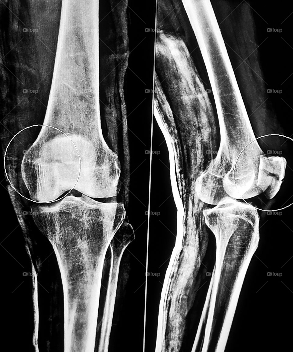 Knee Ap/lateral X-ray View after Plaster procedure
