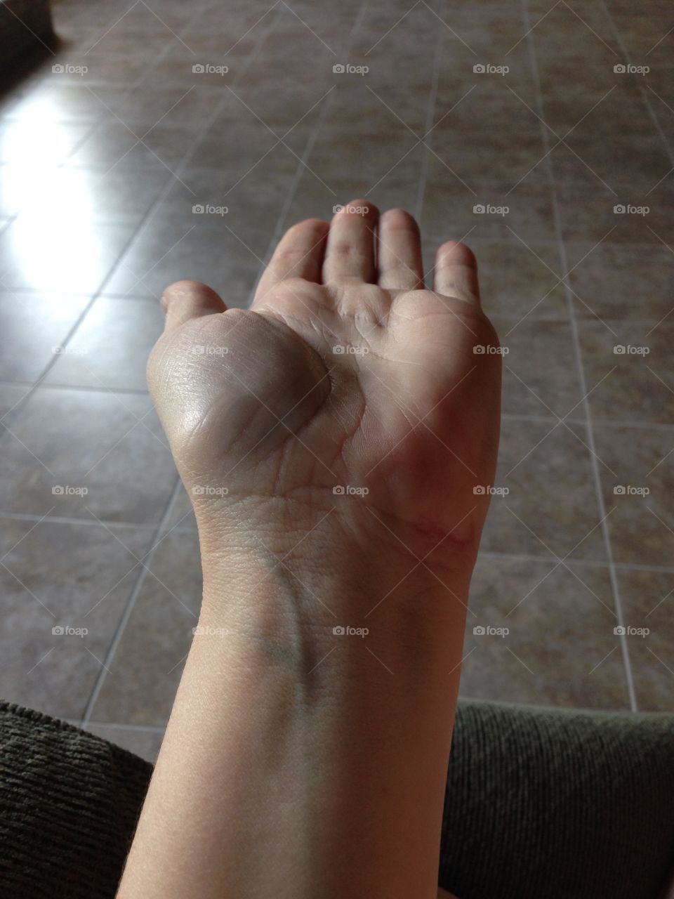 Swelling from thumb hyper extension 