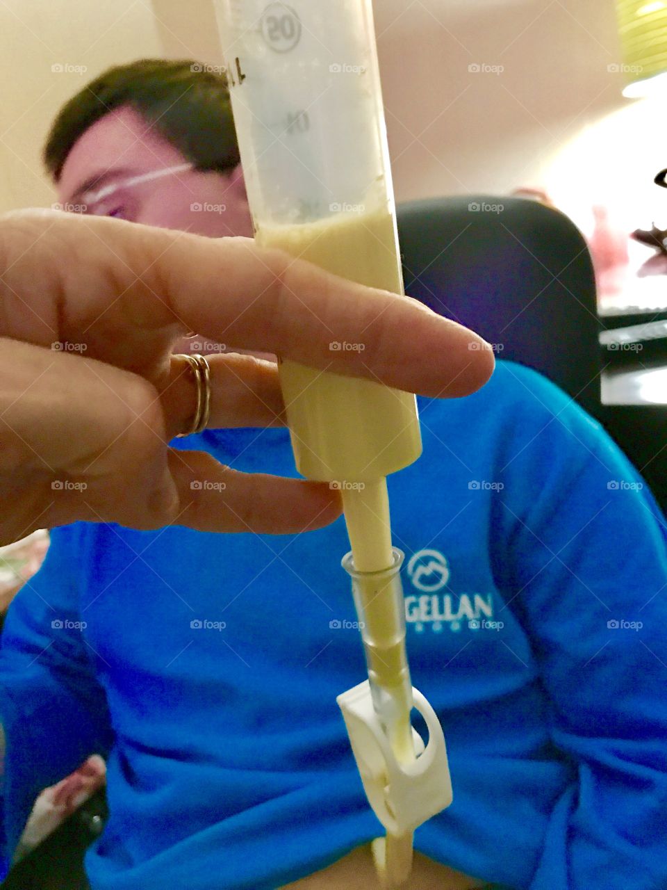 G-Tube G-Button Bolus Feeding