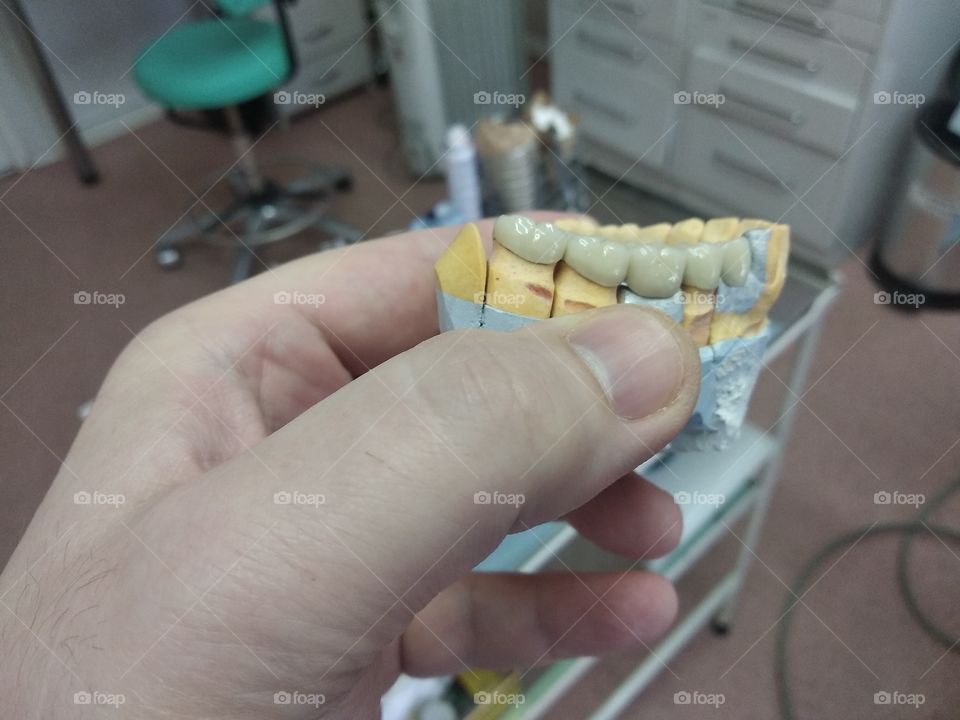 Dental ceramic bridge