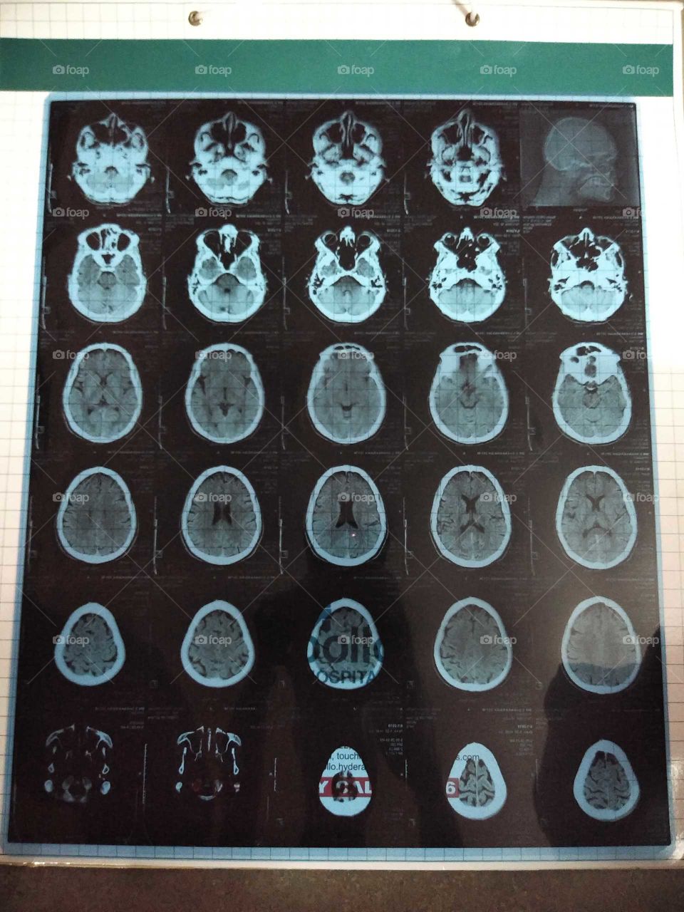 CT scan