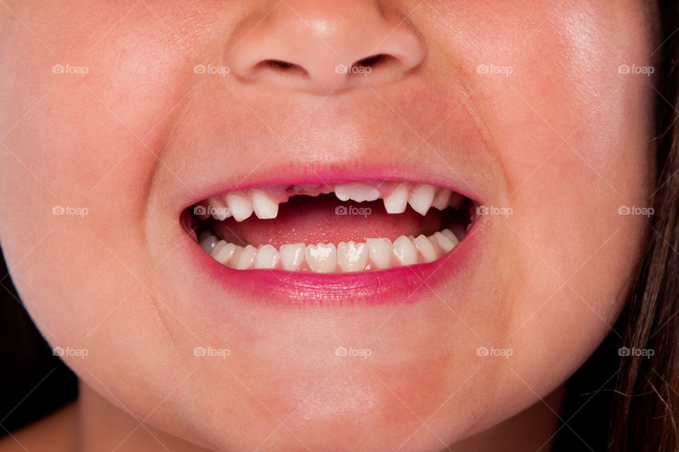 Missing teeth in child development, happy.