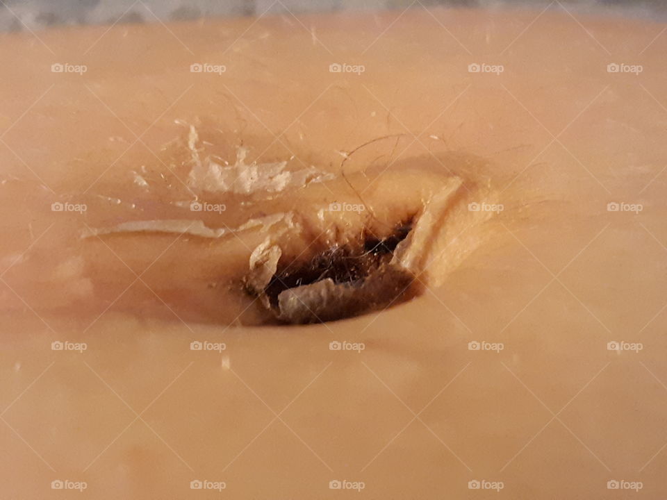 Belly after Ablation healing process