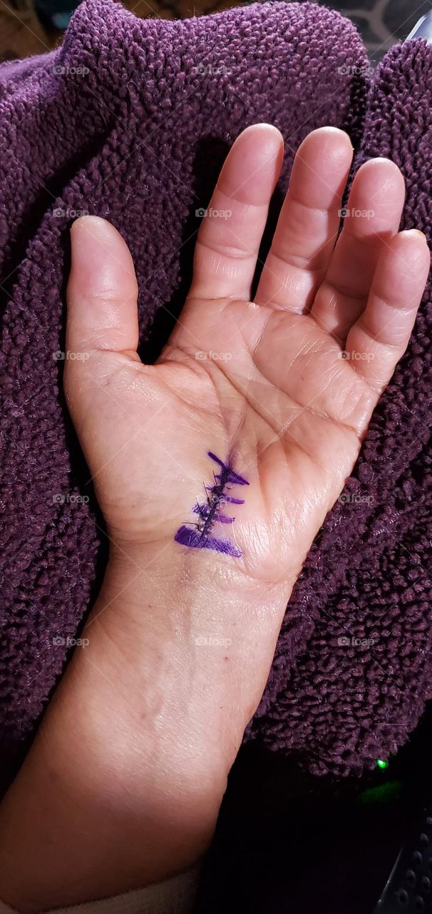 Palm of hand shows markings for stitches. Post operation for carpal tunnel surgery swollen with surgeons incision marked. Palm of hand, pain, movement hurts.