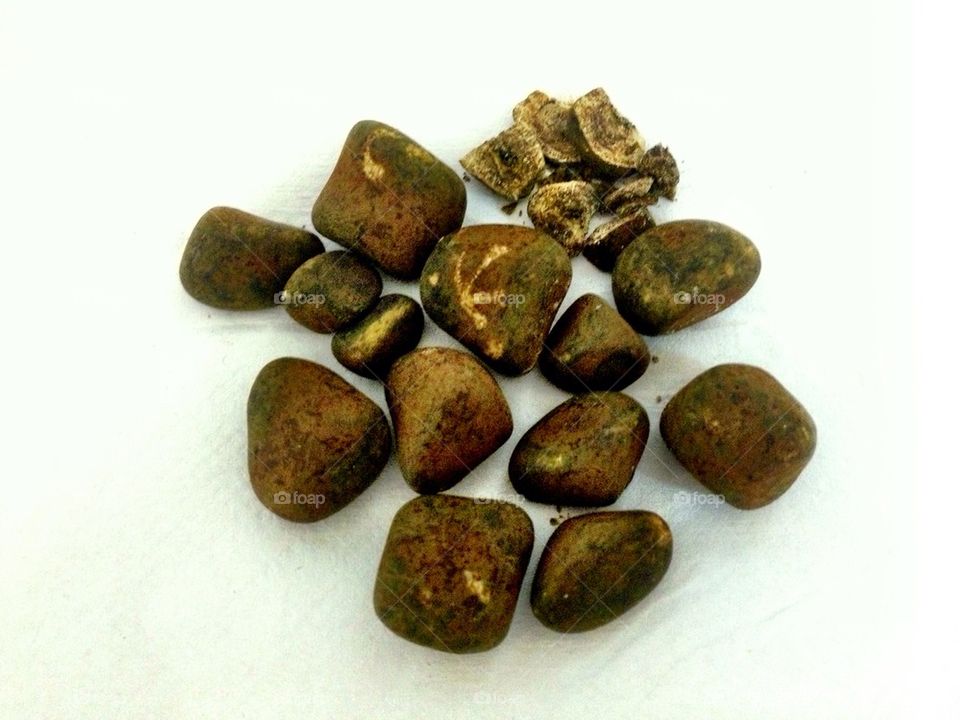 Gallstones