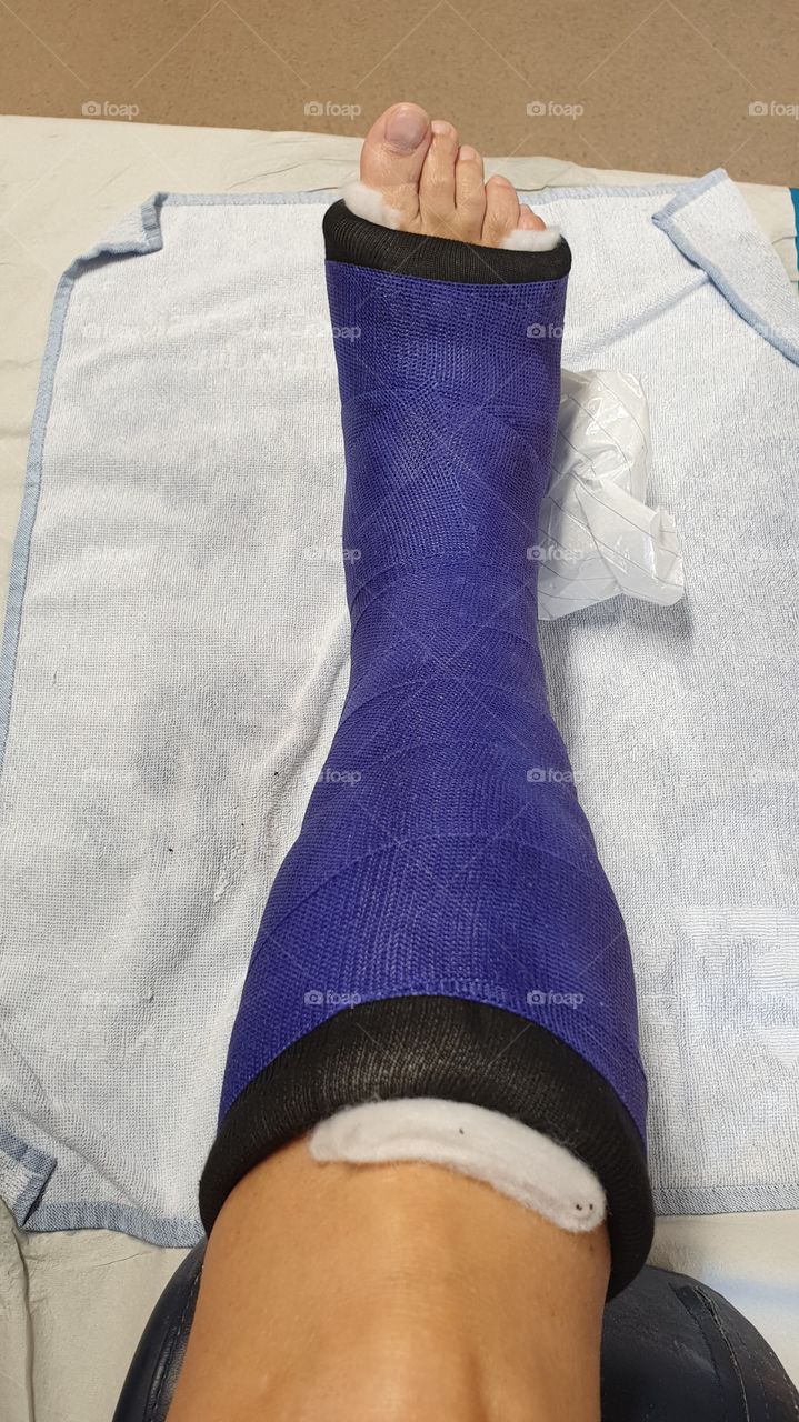 Blue purple black short leg cast foot surgery , blå lila gips underben fotoperation 