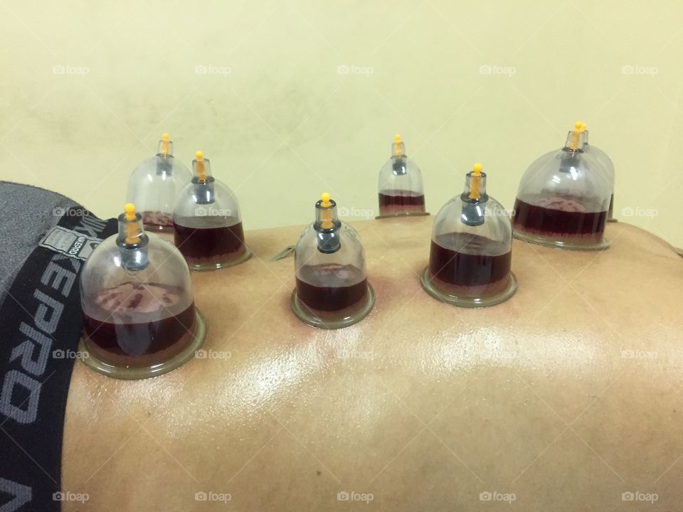 Cupping