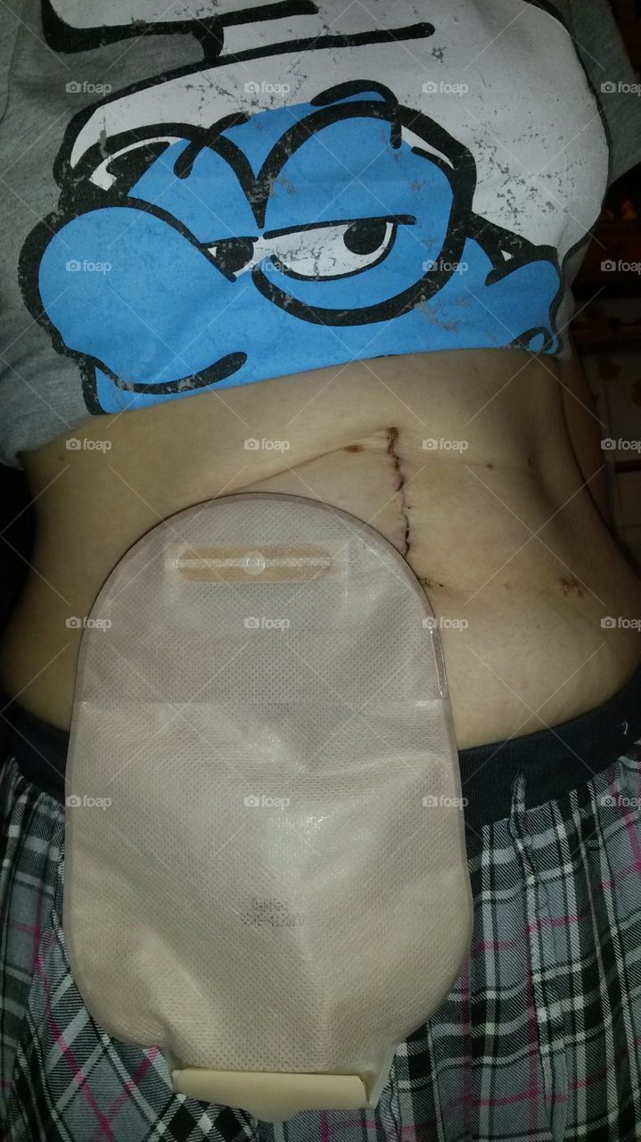 stoma bag after surgery