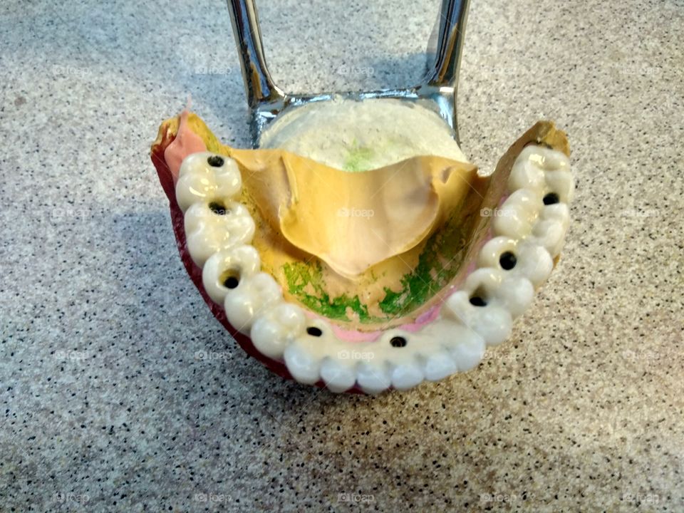Ceramic dental bridge on implantant