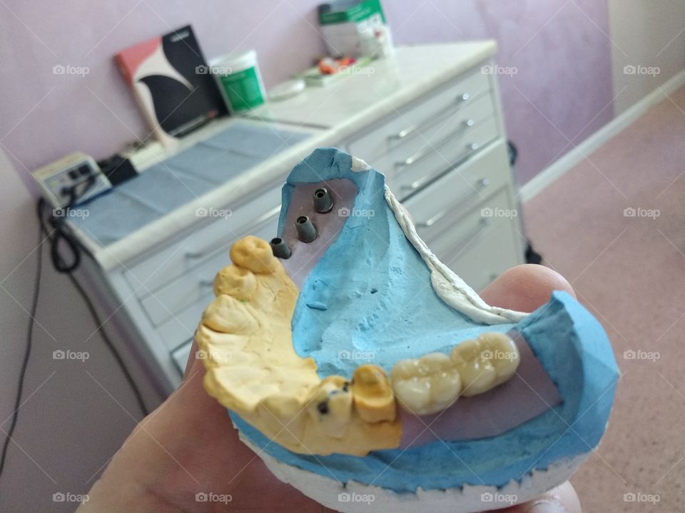 Implantant dental ceramic