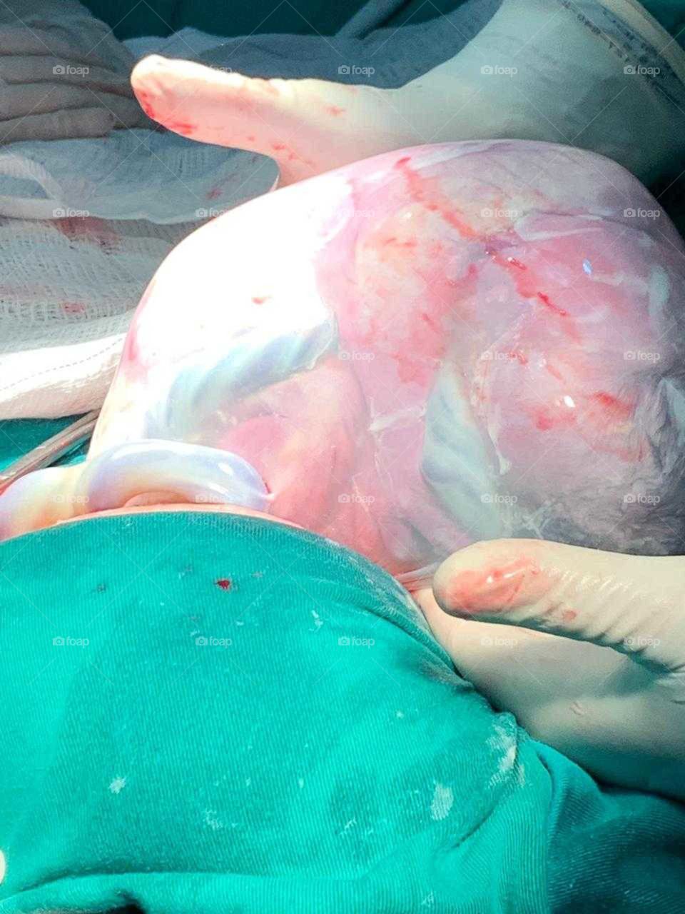 Nascimento de parto cesária com placenta sem romper.