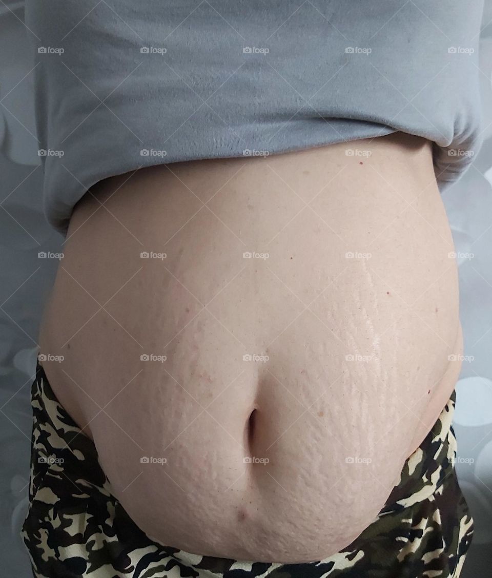 Abdominal fat opration