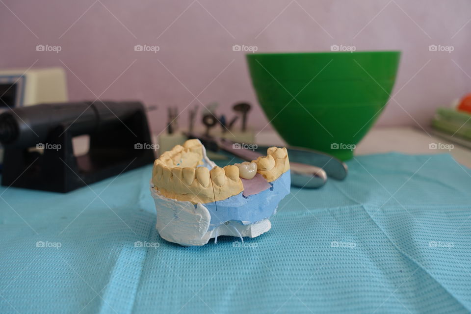 Dental implantant with crown