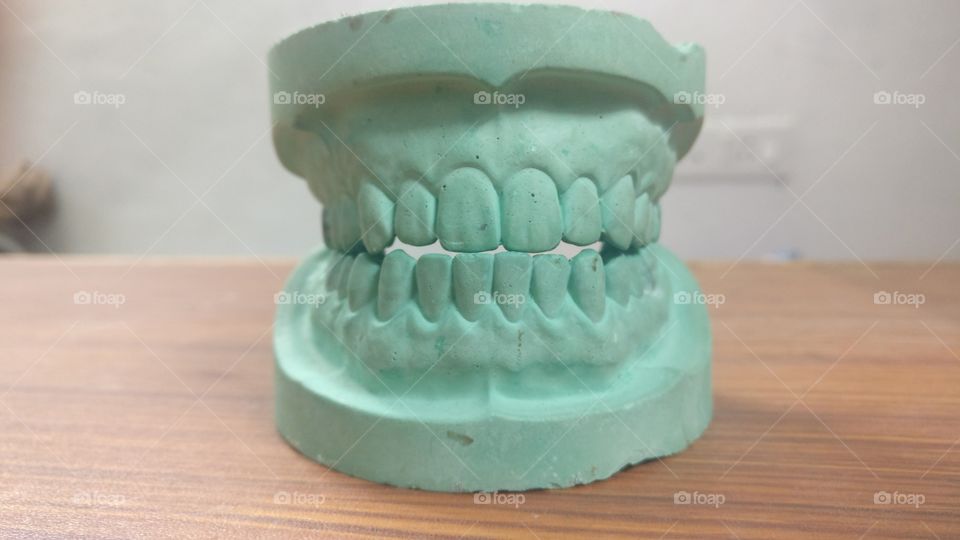 mandibular and maxillary cast