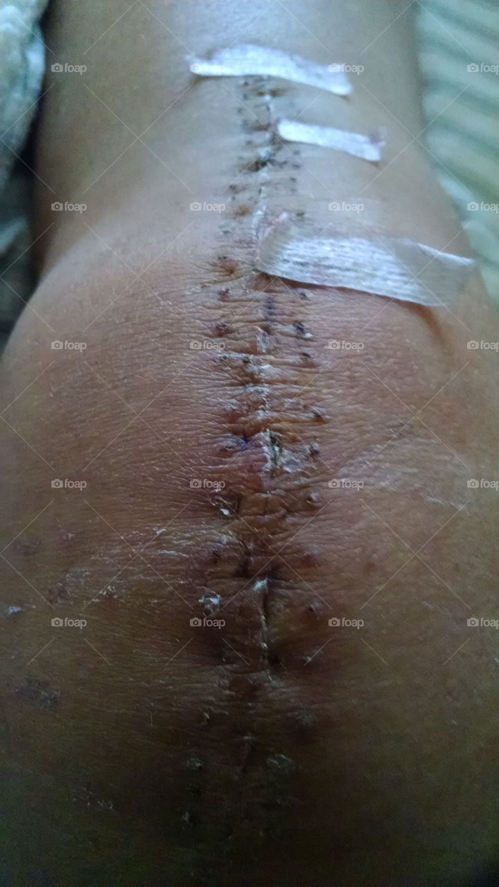 Healing Total Knee Replacement