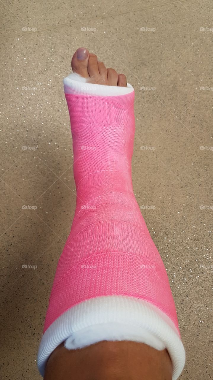 Pink short leg cast foot surgery - rosa gips fotoperation underben 