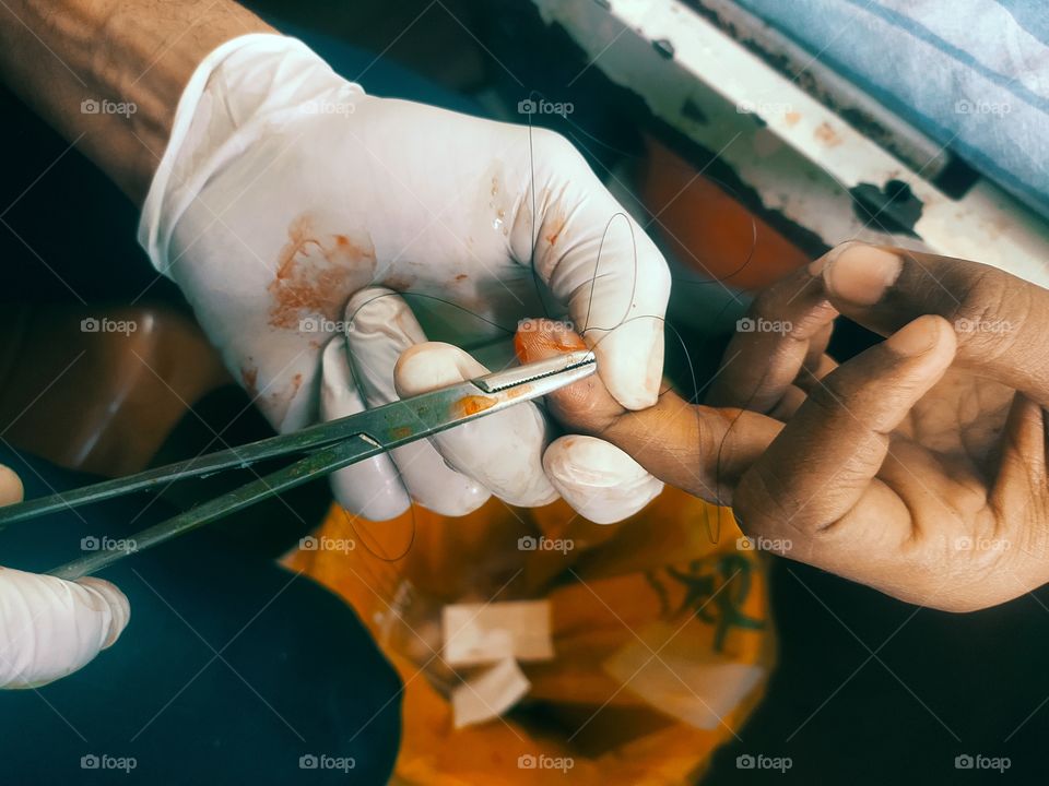 Suturing Process in hospital casualty