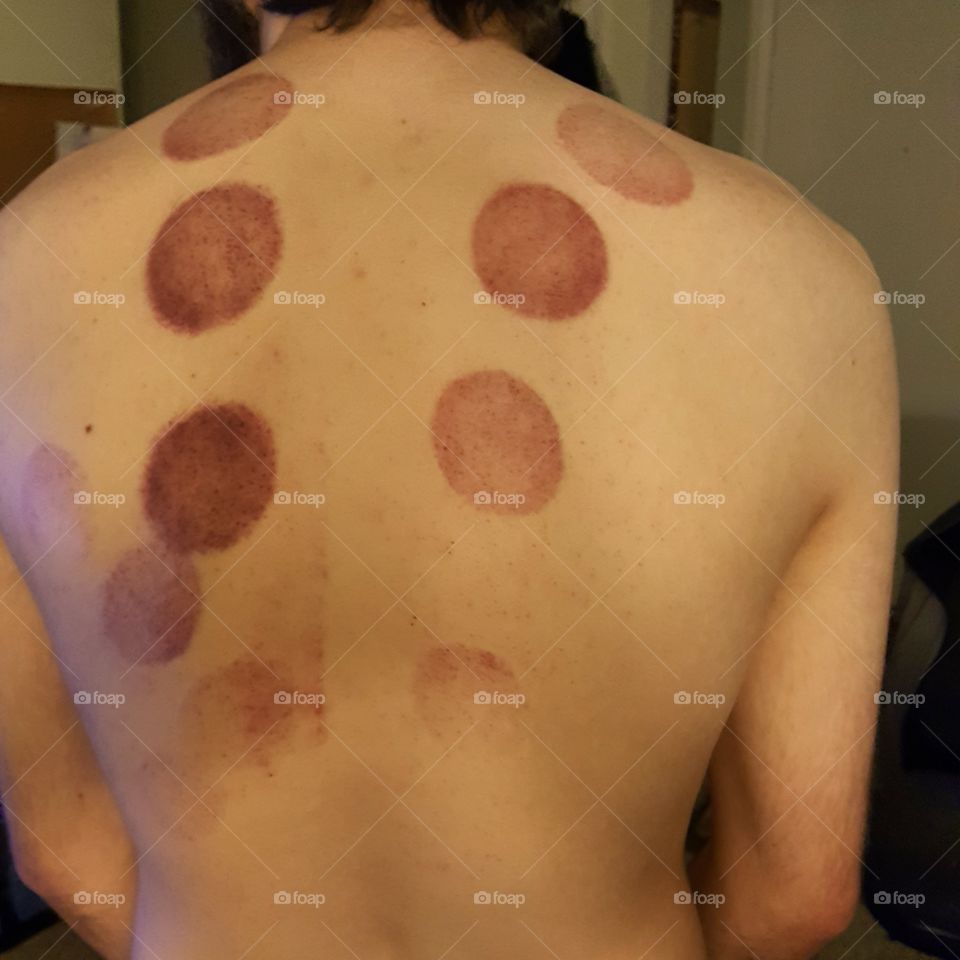 aftermath of cupping