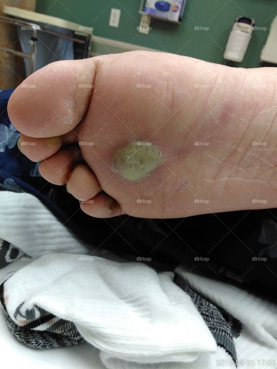 severe blister on foot