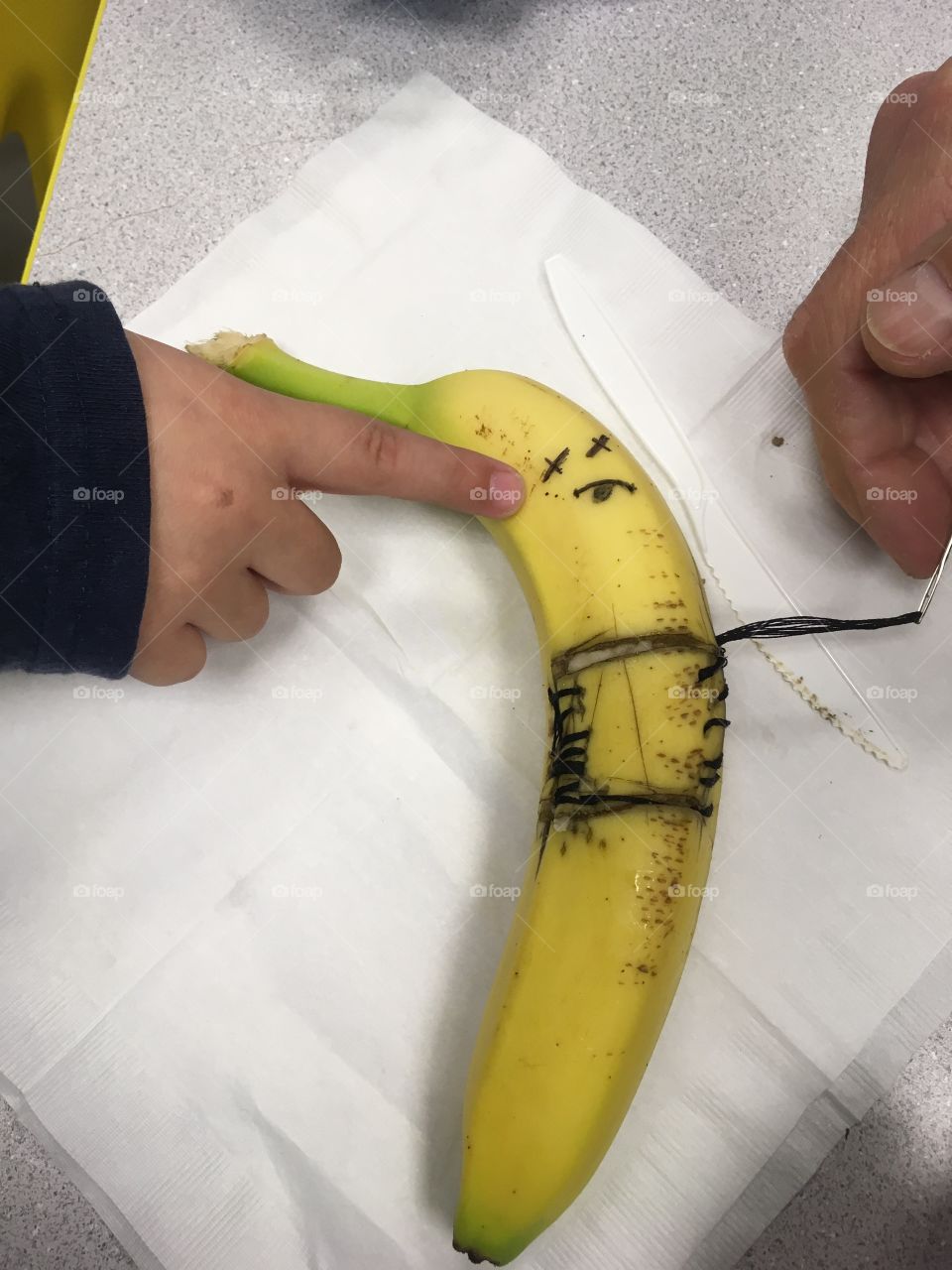 Banana surgery 