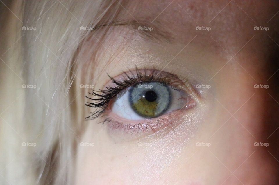 Heterochromia