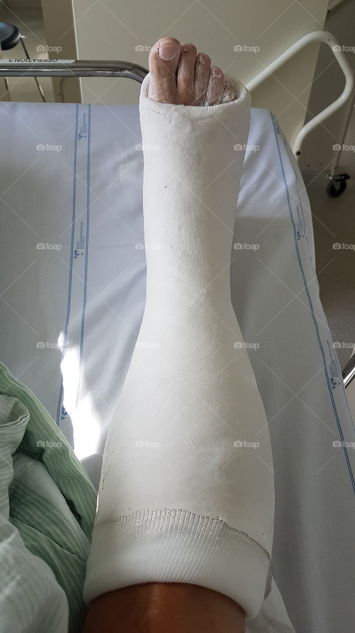 Short leg plaster cast foot surgery - gips fotoperation