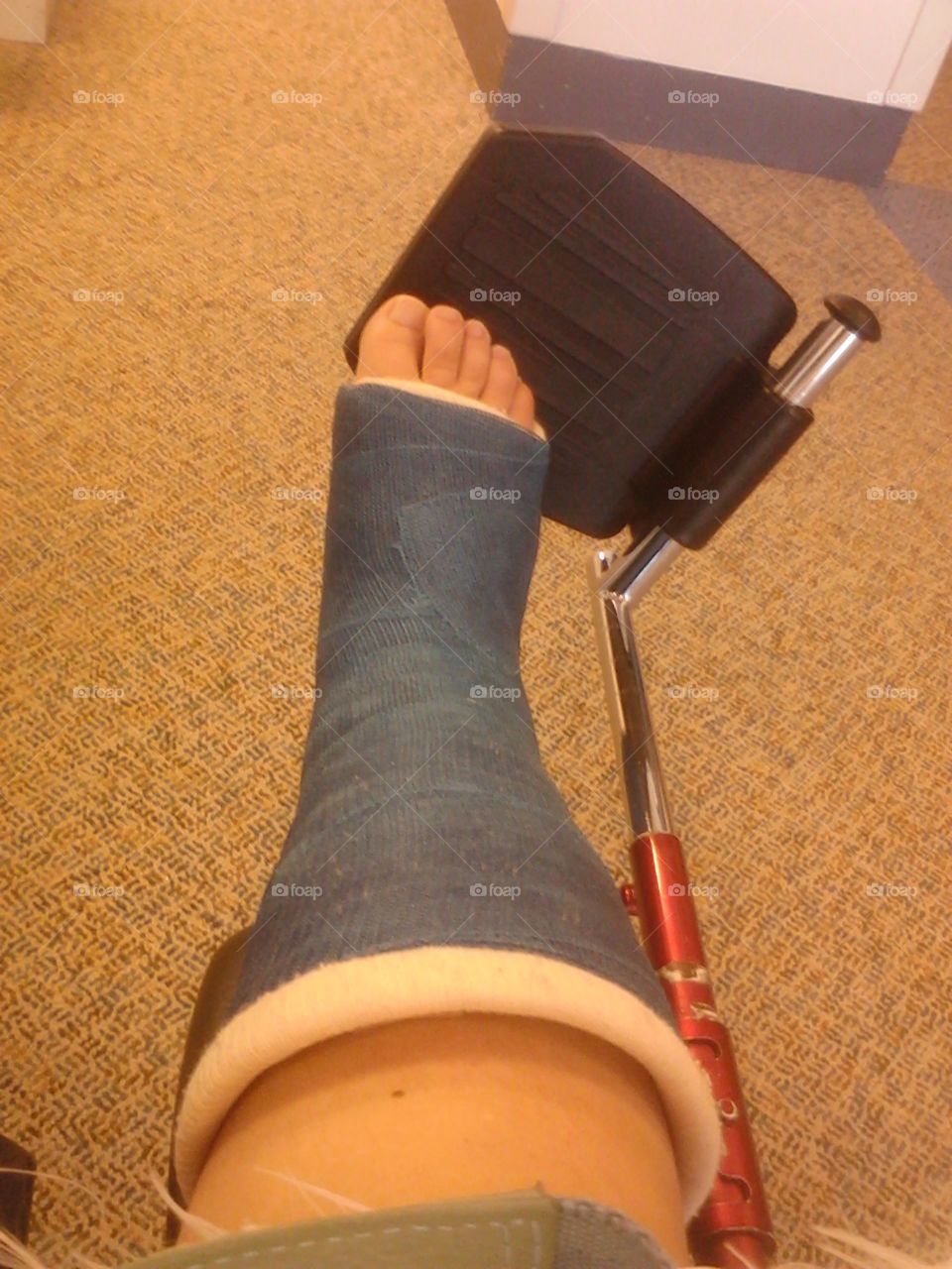 Broken leg in cast