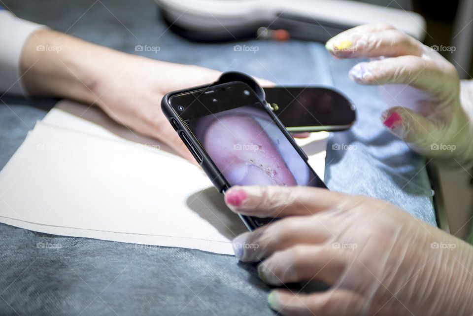 Close-up of the patient's hand and injured finger. Therapeutic examination procedure at the dermatologist.
