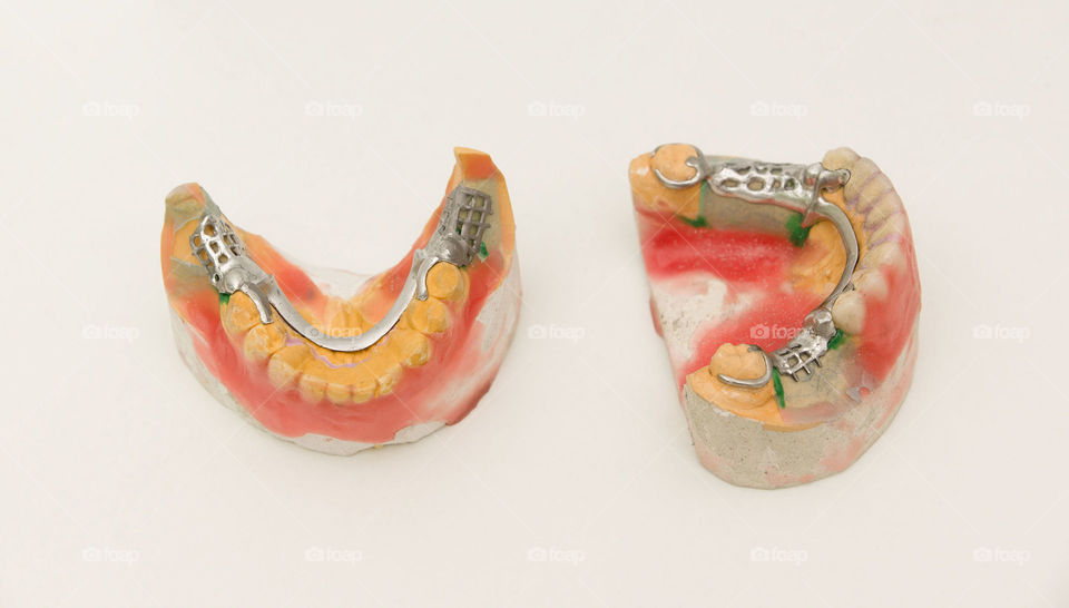 Bugel dentures