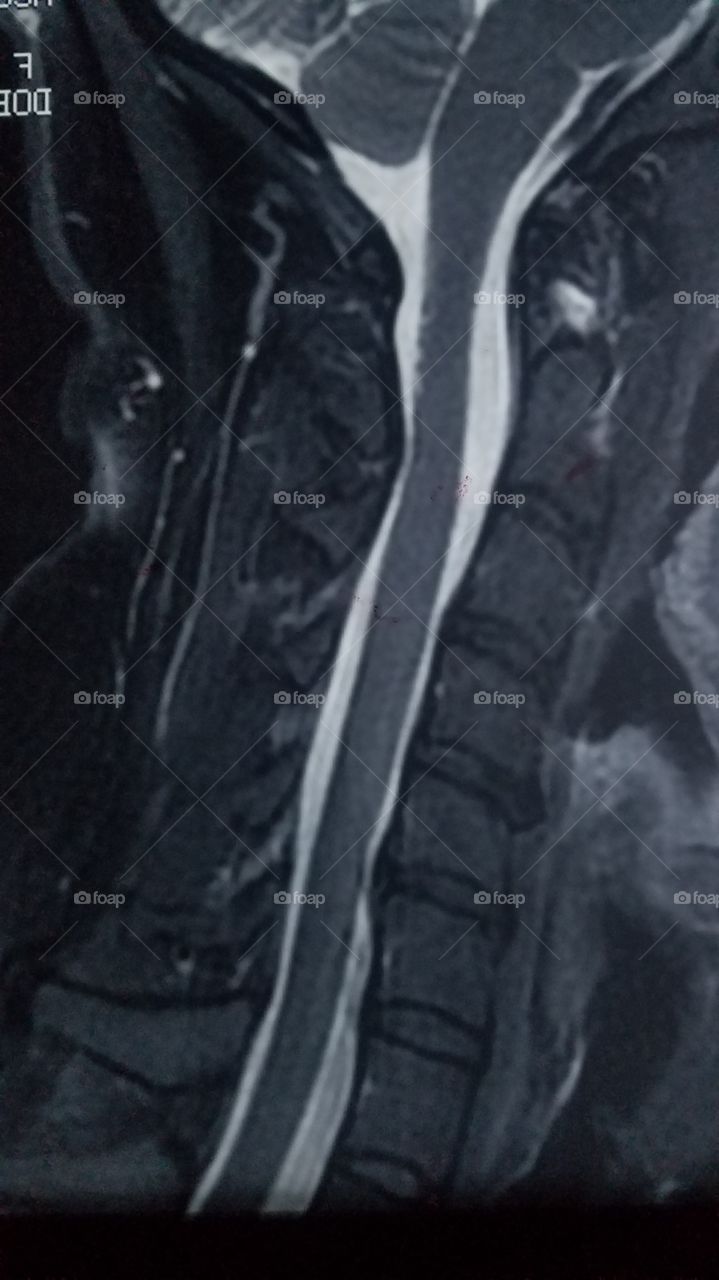 MRI Film Neck