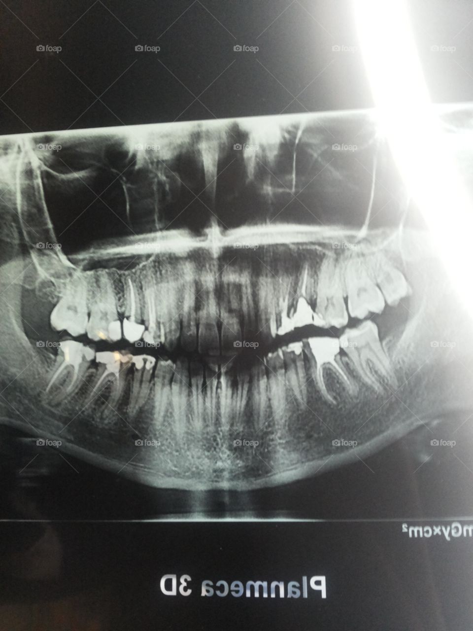 rentgen photo of teeth