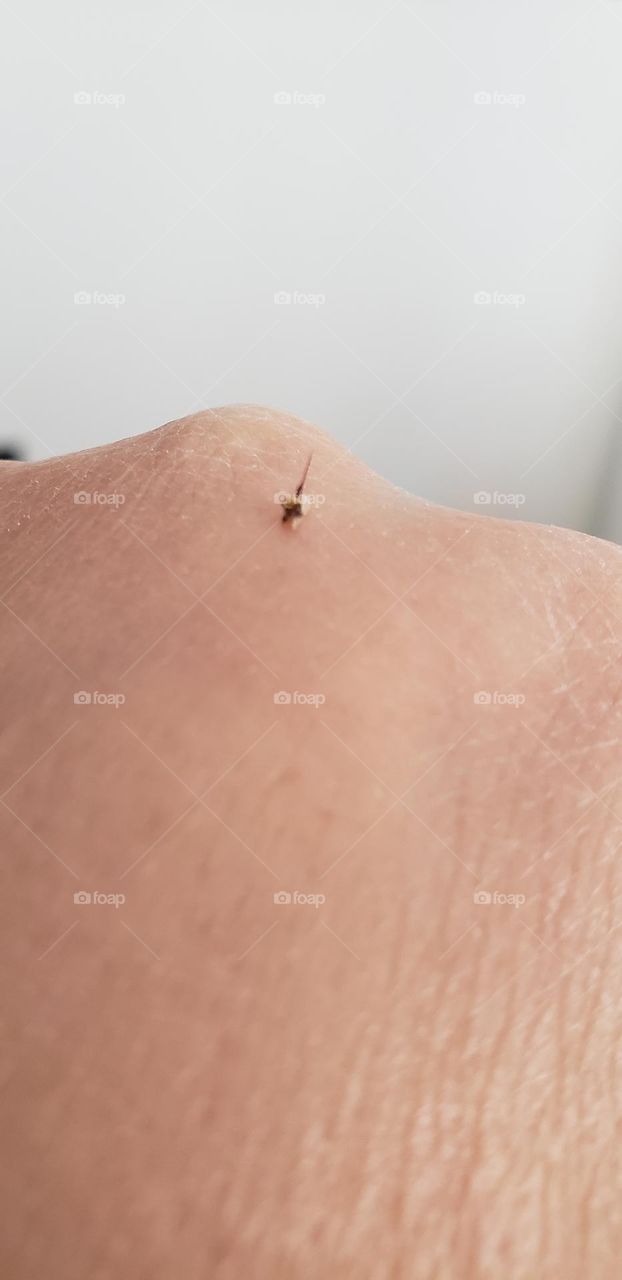bee sting