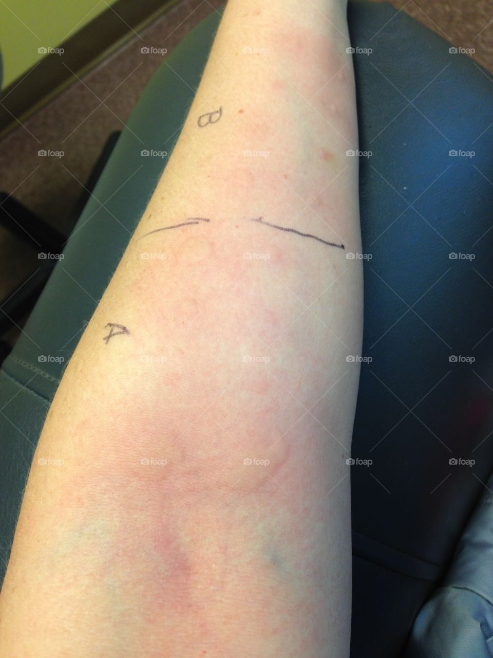 Initial allergy testing