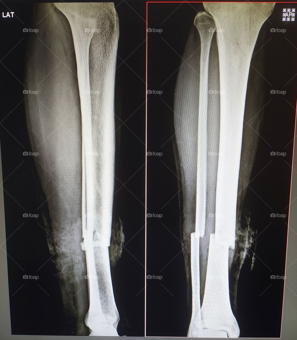Xray view of Leg Ap/Lateral of human body shows bone breaks accidental injury