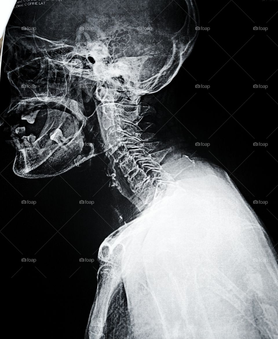 Cervical vertebrae ultrasound