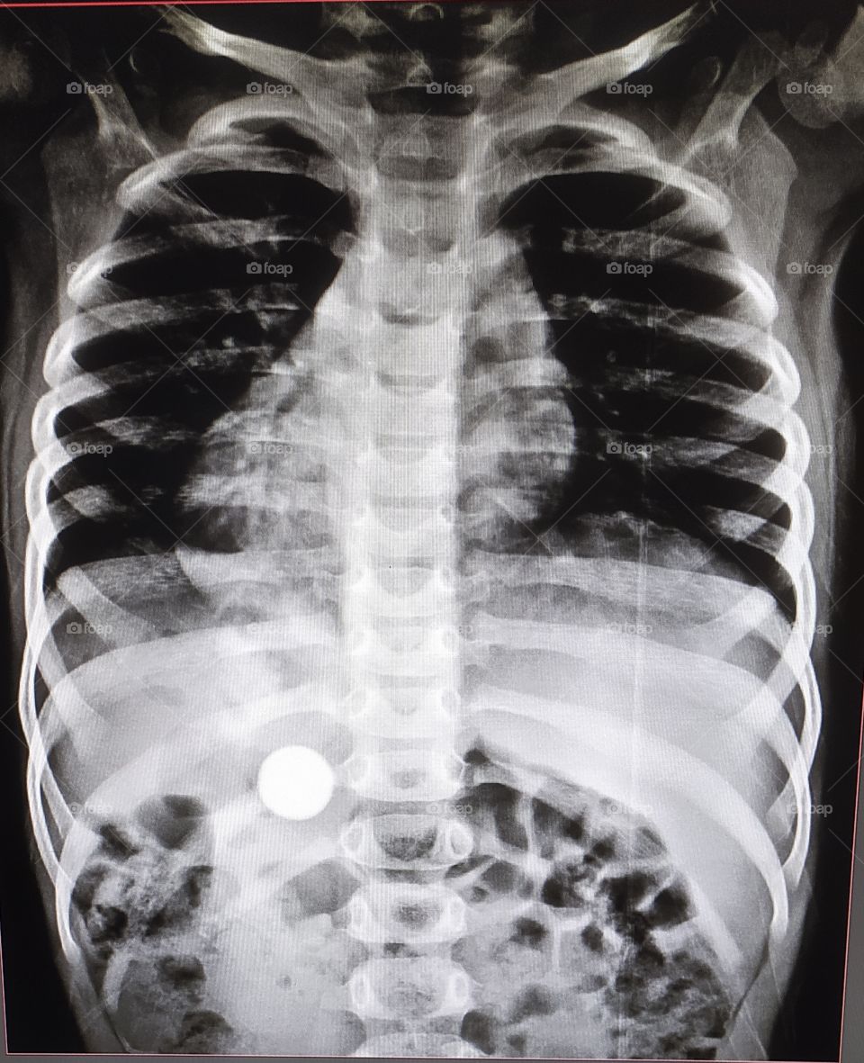 Xray of chest with Abdomain view shows inside marble in abdomain