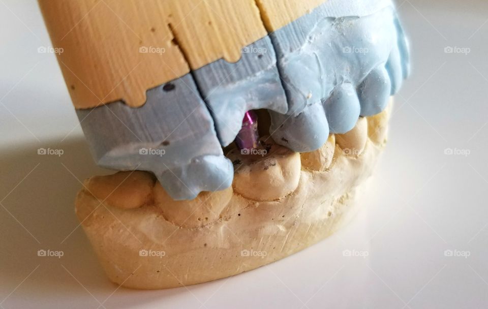 Dental crown impressions