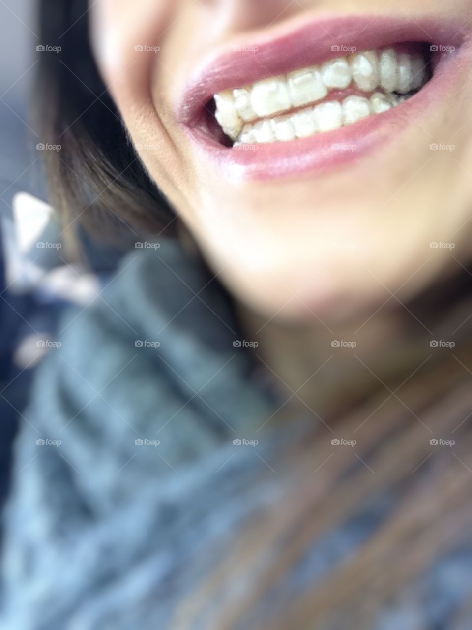 Adult braces . Adult braces