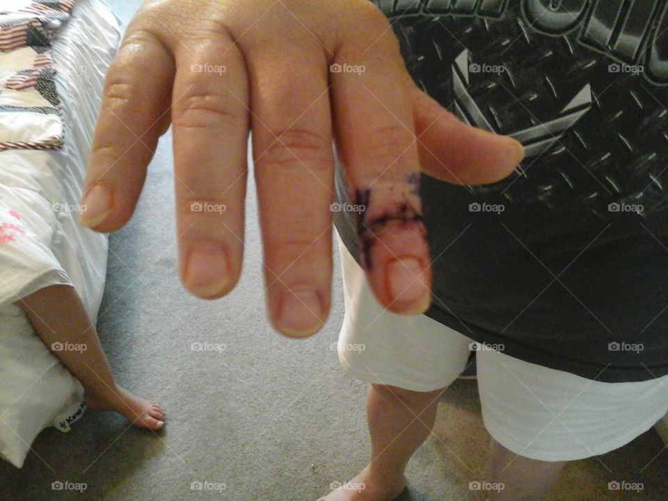 knuckle great cell tumor removed
